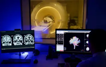 ALFA10: El algoritmo que se anticipará al Alzheimer